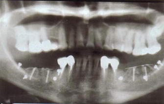 Függőleges augmentáció 3d a felső és alsó állkapocs előkészítése érdekében a fogászati ​​implantáció