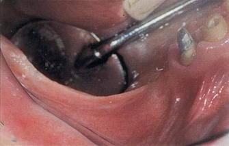 Függőleges 3d fokozódása a felső és alsó állkapocs előkészítése érdekében a fogászati implantáció (nc klinikák dentoalveolar Ortopédia Szájsebészeti fogpótlás esztétikai fogászat implantátum beültetés központ) Függőleges augmentáció 3d a felső és alsó állkapocs előkészítése érdekében a fogászati implantáció