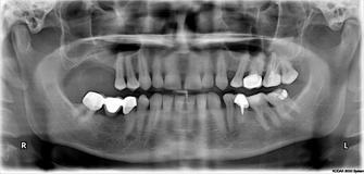 Függőleges augmentáció 3d a felső és alsó állkapocs előkészítése érdekében a fogászati implantáció (pofák) Függőleges augmentáció 3d a felső és alsó állkapocs előkészítése érdekében a fogászati implantáció