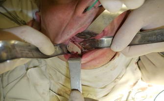 Függőleges augmentáció 3d a felső és alsó állkapocs annak érdekében, hogy előkészítse a fogászati implantátum (felső) Függőleges augmentáció 3d a felső és alsó állkapocs előkészítése érdekében a fogászati implantáció