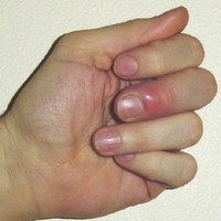A gyulladás körül a köröm (köröm) Körüli gyulladás köröm