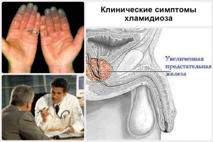 Chlamydia, mikoplazmózis, ureaplasmosis tünetek és kezelés