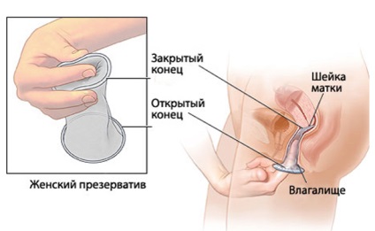 A női óvszer, mint fogamzásgátló módszer, hogy meg kell tudni