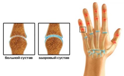 Az ízületi gyulladás tüneteit kefék, a kezek, a kezelés, fotó, rheumatoid arthritis