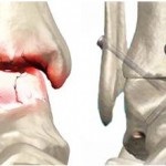 Arthrodesise a boka láb következményei