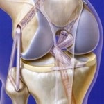 Arthrodesise a boka láb következményei