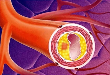 Atherosclerosis az aorta a szív - mi ez, tömítő a falak az aorta és aorta