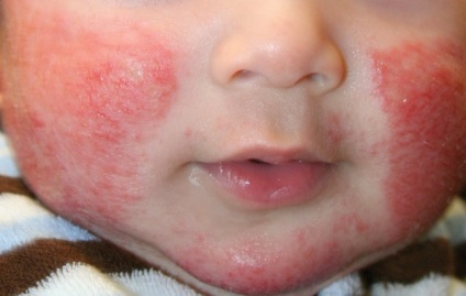 Az atópiás dermatitis gyermekkorban, a kezelés, a diéta és a csalit