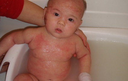 Az atópiás dermatitis gyermekkorban, a kezelés, a diéta és a csalit