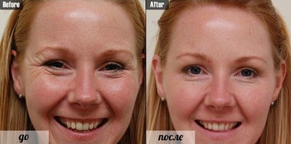 Botox homlokát, mint a Botox homlokát lift (fotó)