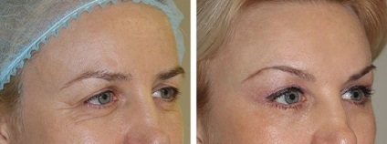 Botox homlokát, mint a Botox homlokát lift (fotó)
