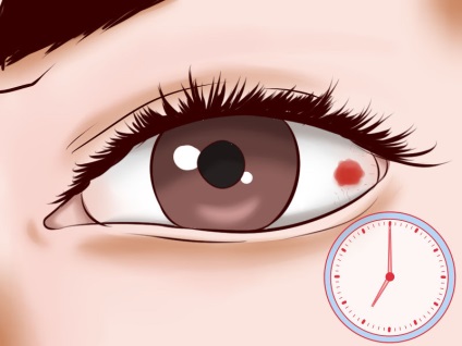 Mi a teendő, ha a szem kivörösödött otthon - vörös szem, hogy mit és hogyan kell kezelni