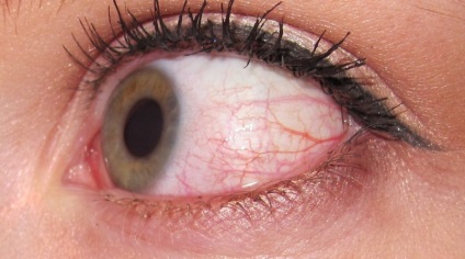 Mi a teendő, ha a szem kivörösödött otthon - vörös szem, hogy mit és hogyan kell kezelni