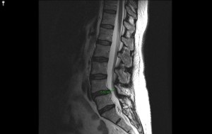 Mi jobb röntgen- vagy MRI a gerinc MRI eltér a röntgen a gerinc