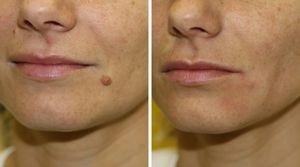 Dermatofibroma okozza a megjelenését, eltávolítása dermatofibroma a lábát, és arckezelés népi (ok) Dermatofibroma okait, dermatofibromas eltávolítása a lábát, és arckezelés népi