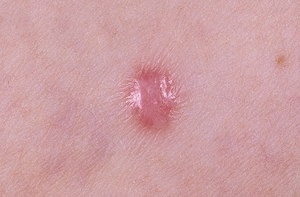 Dermatofibroma okozza a megjelenését, eltávolítása dermatofibroma a lábát, és arckezelés népi (dermatofibroma) Dermatofibroma okait, dermatofibromas eltávolítása a lábát, és arckezelés népi