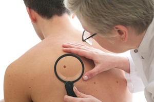 Dermatofibroma okozza a megjelenését, eltávolítása dermatofibroma a lábát, és arckezelés népi (dermatofibroma) Dermatofibroma okait, dermatofibromas eltávolítása a lábát, és arckezelés népi
