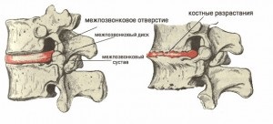A diagnózis osteochondrosis az ágyéki gerinc patogenézisében