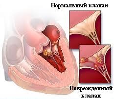Szívbelhártya-gyulladás okai, tünetei, diagnózisa és kezelése fertőzéses szívbelhártya-gyulladás - medglobus medglobus