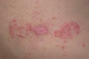 Herpes Body tünetek típusai, kezelése felnőtteknél