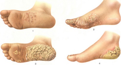 hyperkeratosis a bőr, mi ez, tünetei és kezelése seborrheás hyperkeratosis