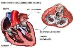 Hypertrophia a jobb kamra a szív