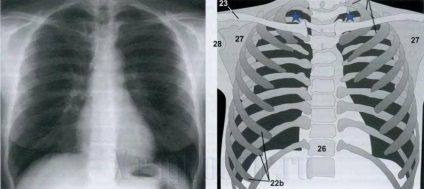 Hogyan kell olvasni a röntgen képeket, a tüdő, a gerinc, a melléküregek