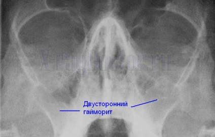 Hogyan kell olvasni a röntgen képeket, a tüdő, a gerinc, a melléküregek