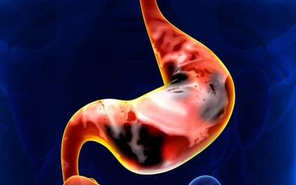 Mi lehet a szövődmények gyomorhurut (gastritis, krónikus szövődménye az akut rehabilitáció) Mi lehet a szövődmények gyomorhurut
