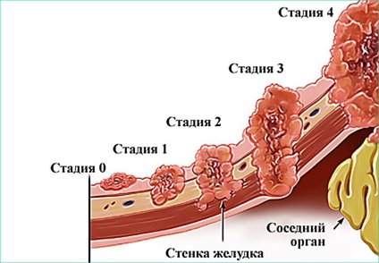 Mi lehet a szövődmények gyomorhurut (gastritis, krónikus szövődménye az akut rehabilitáció) Mi lehet a szövődmények gyomorhurut