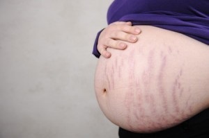 Milyen krémet striák terhes nők segít