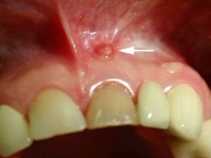 Eltávolítása a duzzanat, amely akkor fordulhat elő a beültetés után, fogak