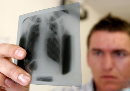 Hogyan véd a tuberkulózis