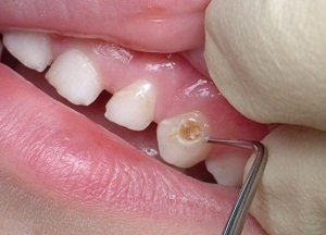cukorbetegség kezelésére periodontitis