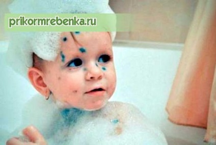 Ha lehetőség van fürdeni a gyerek alatt bárányhimlő bárányhimlő gyermekeknél (bárányhimlő) Ha lehetőség van fürdeni a gyerek alatt bárányhimlő bárányhimlő gyermekeknél