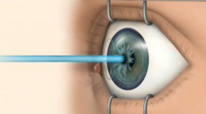 Rövidlátás kezelésére (myopia), fejlesztése, okok és a tünetek