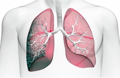 Metatuberkuleznye változások a tüdőben, hogy ez a fejlődés és a kezelés