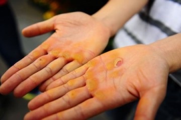 Bőrkeményedés kezében milyen gyorsan hozza száraz oktatás