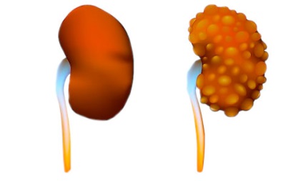 Multikistoz vese, multicystás dysplasia újszülött