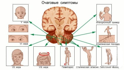A tumor az agytörzs tünetek, kezelés, megelőzés