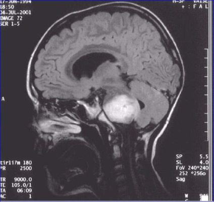 A tumor az agytörzs tünetek, kezelés, megelőzés