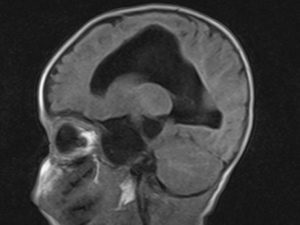 A tumor az agytörzs a gyermekek és felnőttek, a tünetek, a kezelés, prognózis