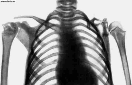 Csontoldást Medical Encyclopedia