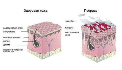 Ellentétben ekcéma, pikkelysömör, hogyan lehet felismerni a betegség megnyilvánulása a különbség a kettő között