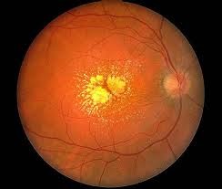 A retina pigmentált anyajegyet szem - ez