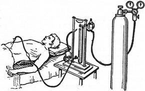 Pneumoperitoneum (aeroperitoneum)