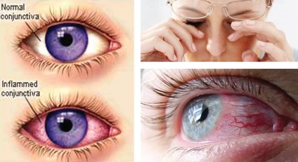 Miért vizenyős szemek - okozza könnyezést és azok kiküszöbölése