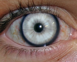 Szaruhártya-homályosodás a szem kezelésére okok
