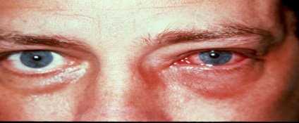 Szaruhártya-homályosodás az emberi szem