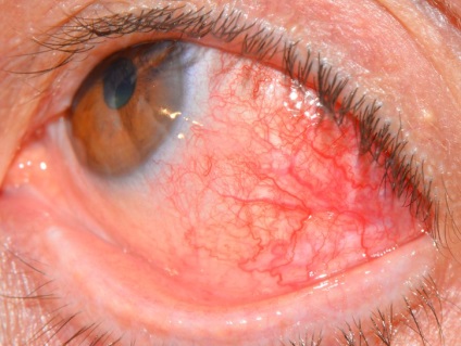 Kár, hogy a szaruhártya a szem kezelésére és hatásainak trauma